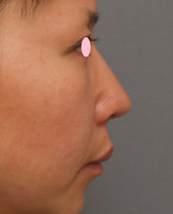 症例写真,耳介軟骨移植（鼻先を出す）の症例 鼻先がやや厚く、丸い40代女性,After,ba_jikai10_b.jpg