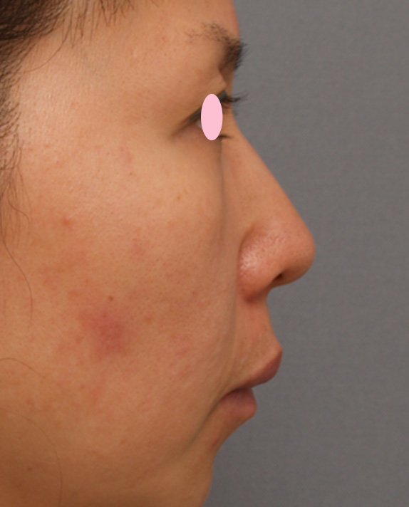 耳介軟骨移植（鼻先を出す）,耳介軟骨移植（鼻先を出す）の症例 鼻先がやや厚く、丸い40代女性,Before,ba_jikai10_b.jpg