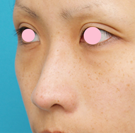 症例写真,耳介軟骨移植（鼻先を出す）の症例 鼻先が少し上を向いている20代女性,After,ba_jikai18_b.jpg