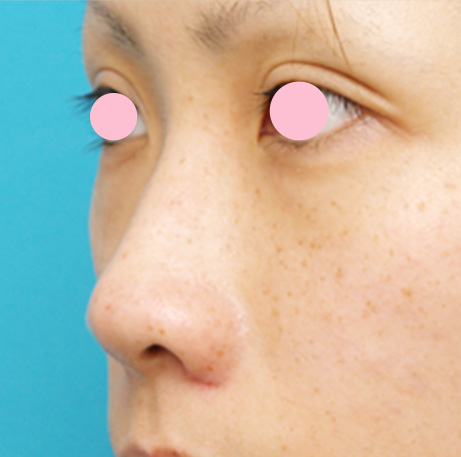 耳介軟骨移植（鼻先を出す）,耳介軟骨移植（鼻先を出す）の症例 鼻先が少し上を向いている20代女性,Before,ba_jikai18_b.jpg