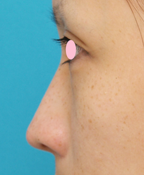 症例写真,耳介軟骨移植（鼻先を出す）の症例 鼻先が少し上を向いている20代女性,After,ba_jikai19_b.jpg