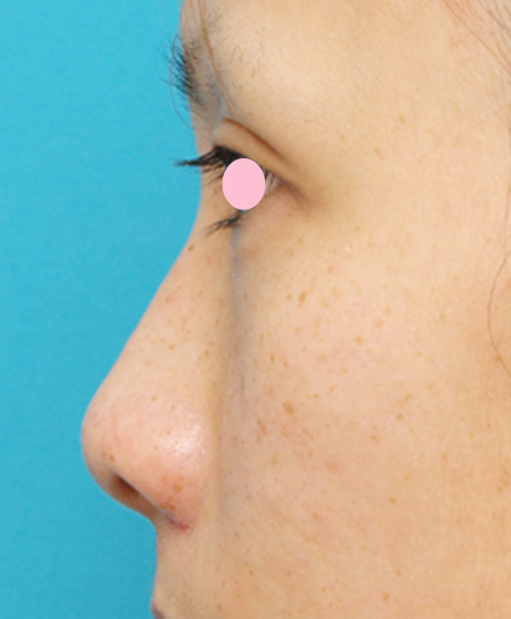 耳介軟骨移植（鼻先を出す）,耳介軟骨移植（鼻先を出す）の症例 鼻先が少し上を向いている20代女性,Before,ba_jikai19_b.jpg