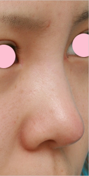 症例写真,耳介軟骨移植（鼻先を出す）の症例 鼻先が低いのが気になっていた10代女性,After（1週間後）,ba_jikai09_b.jpg
