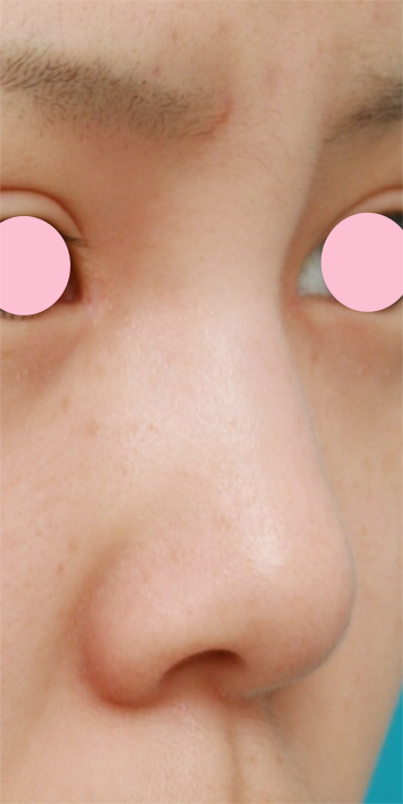 耳介軟骨移植（鼻先を出す）,耳介軟骨移植（鼻先を出す）の症例 鼻先が低いのが気になっていた10代女性,施術前,mainpic_jikai01a.jpg