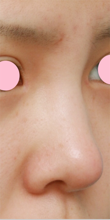 症例写真,耳介軟骨移植（鼻先を出す）の症例 鼻先が低いのが気になっていた10代女性,施術直後,mainpic_jikai01b.jpg