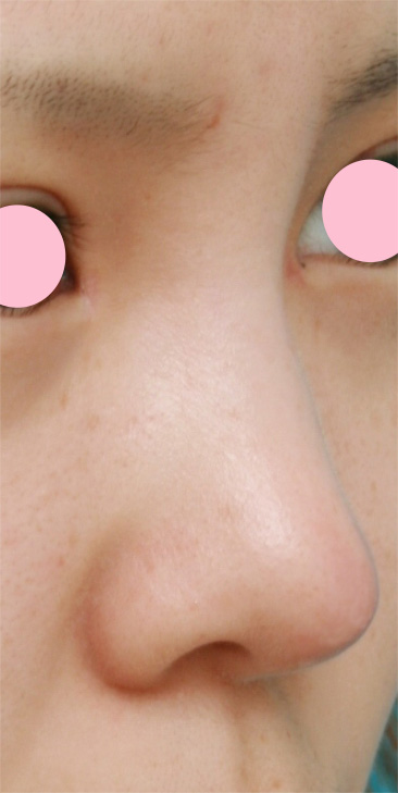 症例写真,耳介軟骨移植（鼻先を出す）の症例 鼻先が低いのが気になっていた10代女性,1週間後,mainpic_jikai01c.jpg