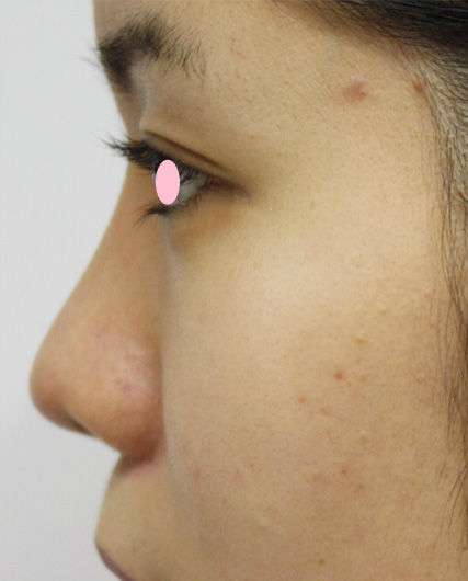 耳介軟骨移植（鼻先を出す）,耳介軟骨移植（鼻先を出す）の症例 横から見たときの鼻先が丸かった女性,After（1週間後）,ba_jikai08_b.jpg
