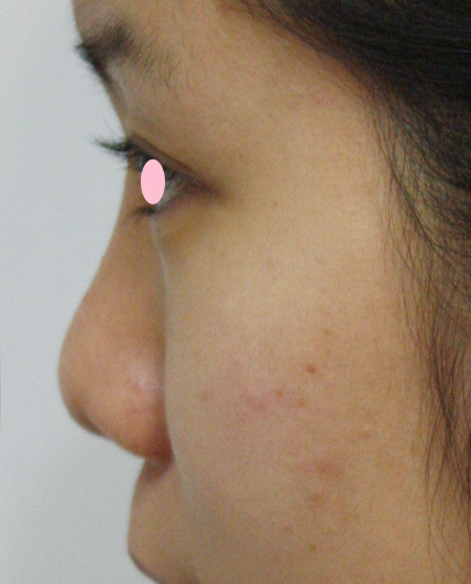 症例写真,耳介軟骨移植（鼻先を出す）の症例 横から見たときの鼻先が丸かった女性,Before,ba_jikai08_b.jpg