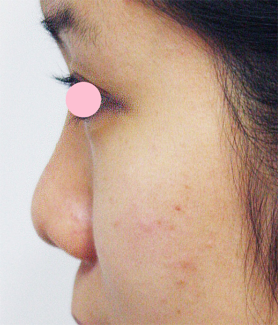 耳介軟骨移植（鼻先を出す）,耳介軟骨移植（鼻先を出す）の症例 横から見たときの鼻先が丸かった女性,施術前,mainpic_jikai02a.jpg