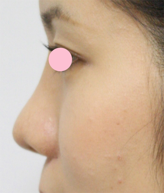 耳介軟骨移植（鼻先を出す）,耳介軟骨移植（鼻先を出す）の症例 横から見たときの鼻先が丸かった女性,施術直後,mainpic_jikai02b.jpg