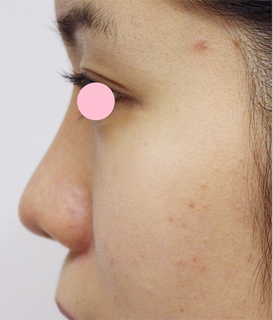 症例写真,耳介軟骨移植（鼻先を出す）の症例 横から見たときの鼻先が丸かった女性,1週間後,mainpic_jikai02c.jpg