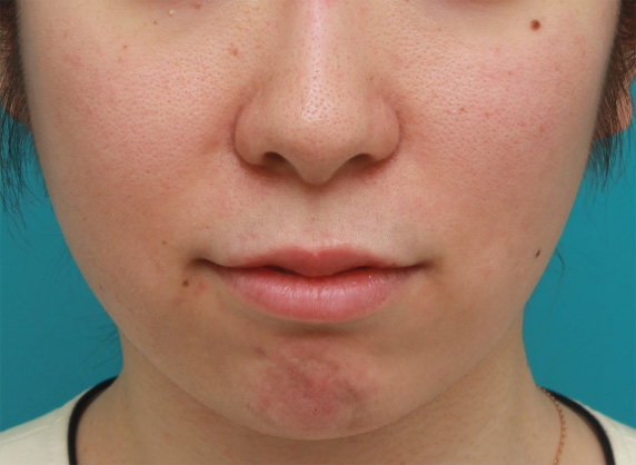 症例写真,口角が上がって見えるように唇にヒアルロン酸注射した症例写真の術前術後画像,After（1週間後）,ba_atsuku29_b.jpg