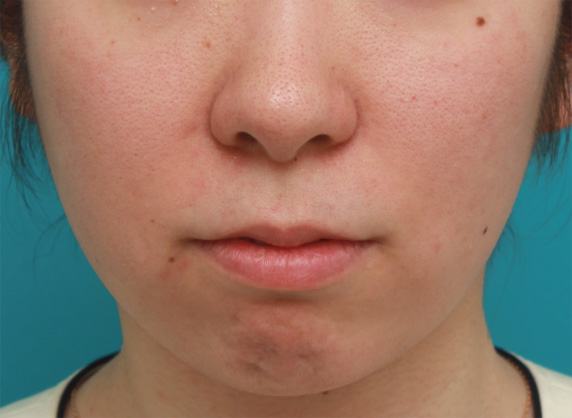 ヒアルロン酸で唇を厚く（ふっくら・アヒル口etc）,口角が上がって見えるように唇にヒアルロン酸注射した症例写真の術前術後画像,Before,ba_atsuku29_b.jpg