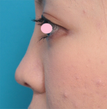 耳介軟骨移植（鼻先を出す）,鼻先に耳介軟骨移植をして鼻先を斜め下方向に出した症例写真,After（1週間後）,ba_jikai22_b.jpg