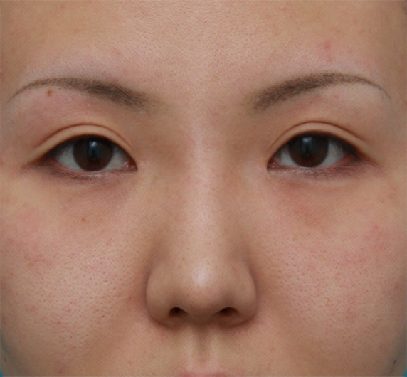耳介軟骨移植+鼻翼（小鼻）縮小+長期持続型ヒアルロン酸注射の症例写真,After（6ヶ月後）,ba_jikai23_a01.jpg