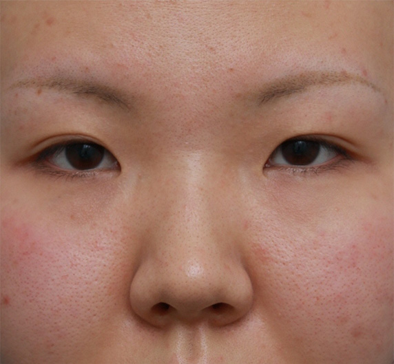 隆鼻注射（ヒアルロン酸注射）,耳介軟骨移植+鼻翼（小鼻）縮小+長期持続型ヒアルロン酸注射の症例写真,Before,ba_jikai23_b.jpg