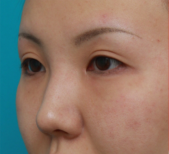 隆鼻注射（ヒアルロン酸注射）,耳介軟骨移植+鼻翼（小鼻）縮小+長期持続型ヒアルロン酸注射の症例写真,After（6ヶ月後）,ba_jikai24_b.jpg