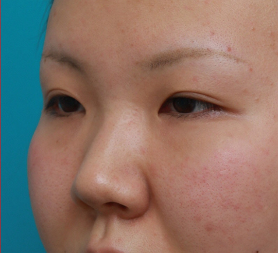 隆鼻注射（ヒアルロン酸注射）,耳介軟骨移植+鼻翼（小鼻）縮小+長期持続型ヒアルロン酸注射の症例写真,Before,ba_jikai24_b.jpg