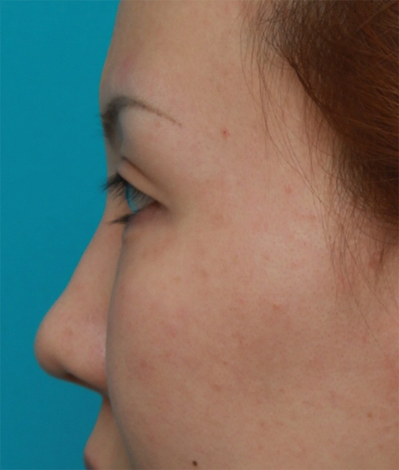 隆鼻注射（ヒアルロン酸注射）,耳介軟骨移植+鼻翼（小鼻）縮小+長期持続型ヒアルロン酸注射の症例写真,After（6ヶ月後）,ba_jikai25_b.jpg
