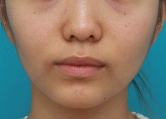上下の唇にヒアルロン酸注射をして、タラコ唇にならない程度に膨らませた症例写真の術前術後の画像,After,ba_atsuku28_a01.jpg