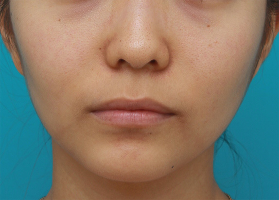 上下の唇にヒアルロン酸注射をして、タラコ唇にならない程度に膨らませた症例写真の術前術後の画像,Before,ba_atsuku28_b.jpg