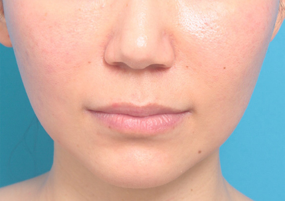 ヒアルロン酸で唇を厚く（ふっくら・アヒル口etc）,唇にヒアルロン酸注射をしてアヒル口を作った症例写真,Before,ba_atsuku26_b.jpg