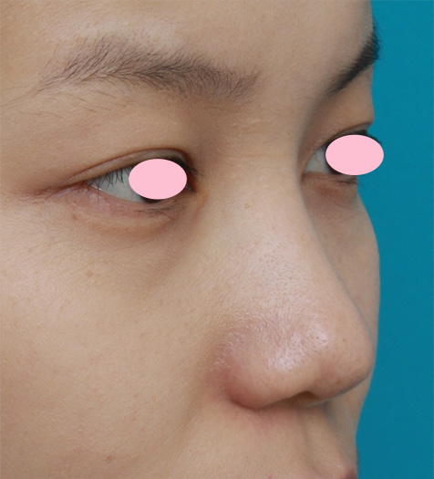鼻翼縮小（小鼻縮小）,鼻先と鼻柱基部に耳介軟骨移植をし、鼻翼（小鼻）縮小した症例写真,After（2ヶ月後）,ba_jikai27_b.jpg