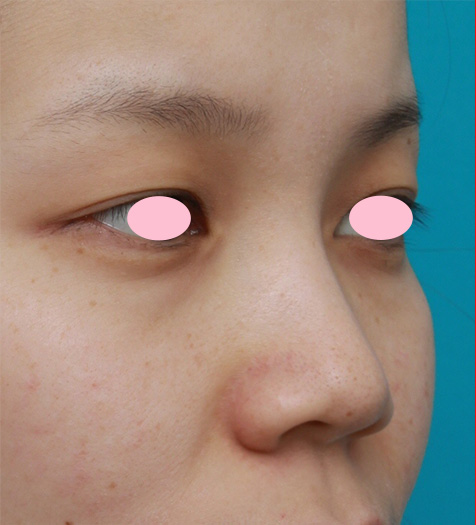 鼻翼縮小（小鼻縮小）,鼻先と鼻柱基部に耳介軟骨移植をし、鼻翼（小鼻）縮小した症例写真,Before,ba_jikai27_b.jpg