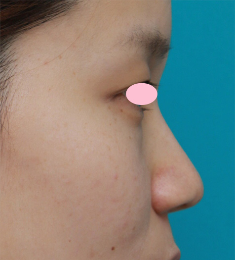 耳介軟骨移植（鼻先を出す）,鼻先と鼻柱基部に耳介軟骨移植をし、鼻翼（小鼻）縮小した症例写真,After（2ヶ月後）,ba_jikai28_b.jpg