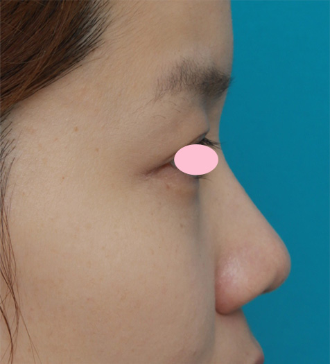耳介軟骨移植（鼻先を出す）,鼻先と鼻柱基部に耳介軟骨移植をし、鼻翼（小鼻）縮小した症例写真,Before,ba_jikai28_b.jpg