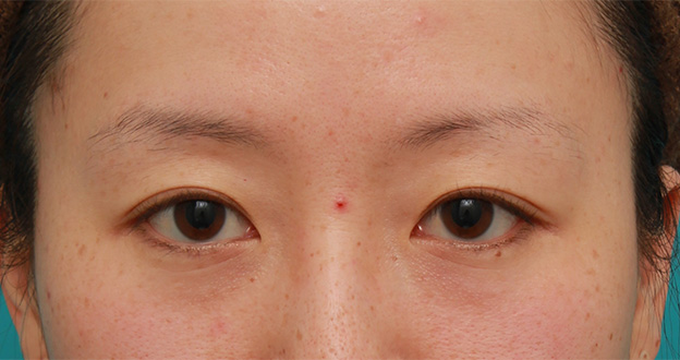 目の下の脂肪取り,片目のみ目の下の脂肪取りをして左右対称に近づけた症例写真の術前術後画像,After（4ヶ月後）,ba_shibo13_a01.jpg