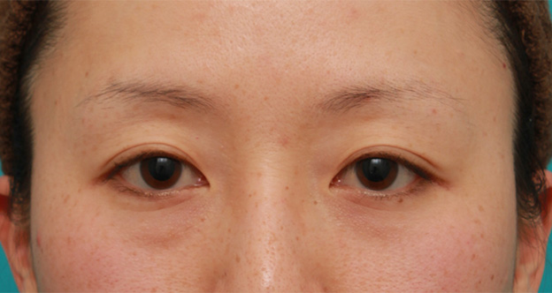 目の下の脂肪取り,片目のみ目の下の脂肪取りをして左右対称に近づけた症例写真の術前術後画像,Before,ba_shibo13_b.jpg