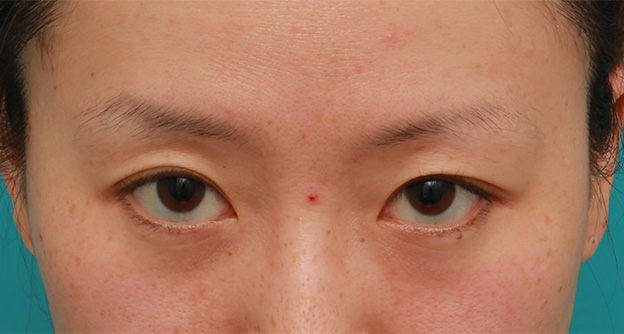 目の下の脂肪取り,片目のみ目の下の脂肪取りをして左右対称に近づけた症例写真の術前術後画像,After（4ヶ月後）,ba_shibo14_b.jpg