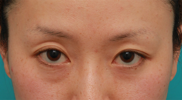 目の下の脂肪取り,片目のみ目の下の脂肪取りをして左右対称に近づけた症例写真の術前術後画像,Before,ba_shibo14_b.jpg