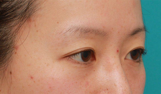 目の下の脂肪取り,片目のみ目の下の脂肪取りをして左右対称に近づけた症例写真の術前術後画像,After（4ヶ月後）,ba_shibo15_b.jpg