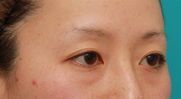 目の下の脂肪取り,片目のみ目の下の脂肪取りをして左右対称に近づけた症例写真の術前術後画像,Before,ba_shibo15_b.jpg