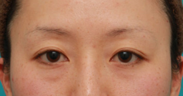 目の下の脂肪取り,片目のみ目の下の脂肪取りをして左右対称に近づけた症例写真の術前術後画像,手術前,mainpic_shibo07a.jpg