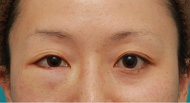 目の下の脂肪取り,片目のみ目の下の脂肪取りをして左右対称に近づけた症例写真の術前術後画像,手術直後,mainpic_shibo07b.jpg