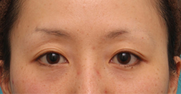 目の下の脂肪取り,片目のみ目の下の脂肪取りをして左右対称に近づけた症例写真の術前術後画像,1週間後,mainpic_shibo07c.jpg