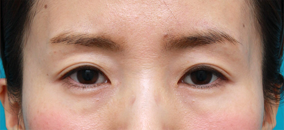 くぼみ目修正（ヒアルロン酸注射）,目の上の窪みにヒアルロン酸を注射し、二重のラインをはっきりさせた症例写真,After（メイクなし）,ba_kubomi06_b.jpg