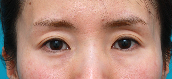 くぼみ目修正（ヒアルロン酸注射）,目の上の窪みにヒアルロン酸を注射し、二重のラインをはっきりさせた症例写真,Before,ba_kubomi06_b.jpg