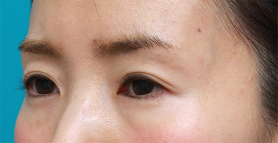 くぼみ目修正（ヒアルロン酸注射）,目の上の窪みにヒアルロン酸を注射し、二重のラインをはっきりさせた症例写真,After（メイクなし）,ba_kubomi07_b.jpg