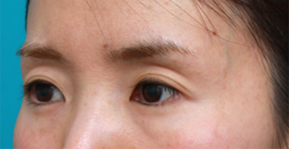 くぼみ目修正（ヒアルロン酸注射）,目の上の窪みにヒアルロン酸を注射し、二重のラインをはっきりさせた症例写真,Before,ba_kubomi07_b.jpg