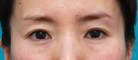くぼみ目修正（ヒアルロン酸注射）,目の上の窪みにヒアルロン酸を注射し、二重のラインをはっきりさせた症例写真,注射直後,mainpic_kubomi01b.jpg
