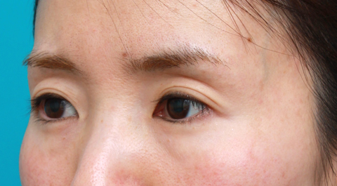 くぼみ目修正（ヒアルロン酸注射）,目の上の窪みにヒアルロン酸を注射し、二重のラインをはっきりさせた症例写真,注射前,mainpic_kubomi02a.jpg