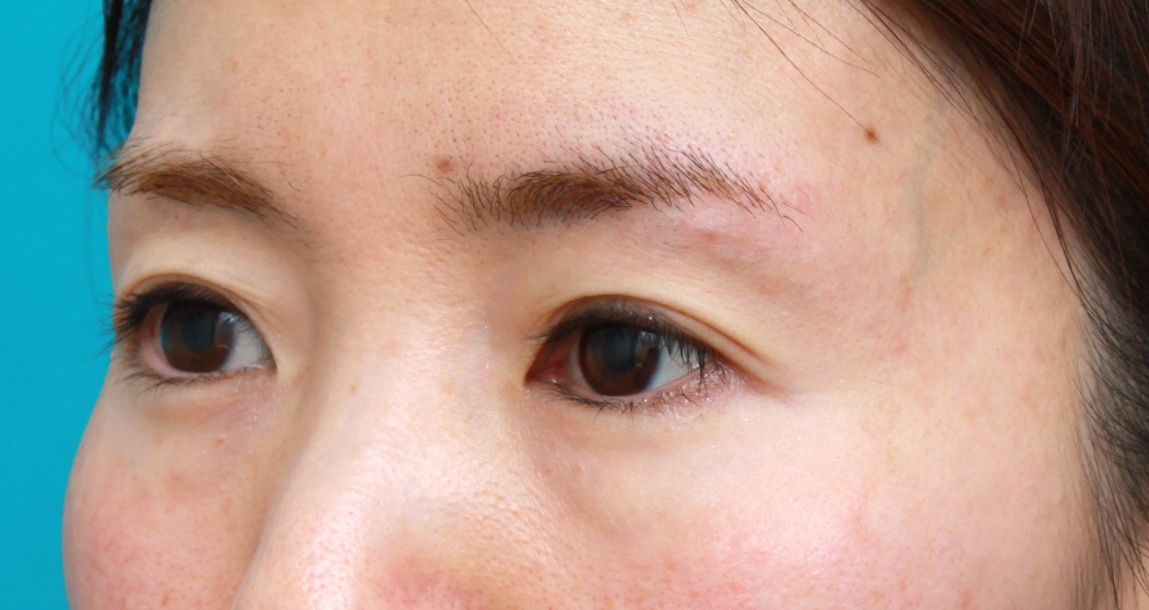 くぼみ目修正（ヒアルロン酸注射）,目の上の窪みにヒアルロン酸を注射し、二重のラインをはっきりさせた症例写真,注射直後,mainpic_kubomi02b.jpg