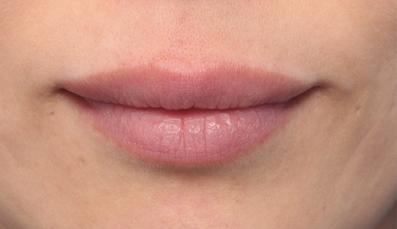 ヒアルロン酸で唇を厚く（ふっくら・アヒル口etc）,ヒアルロン酸で唇をふっくらさせて、軽いアヒル口にした症例写真,After,ba_atsuku16_a01.jpg