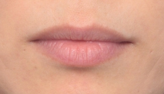 ヒアルロン酸で唇を厚く（ふっくら・アヒル口etc）,ヒアルロン酸で唇をふっくらさせて、軽いアヒル口にした症例写真,Before,ba_atsuku16_b.jpg