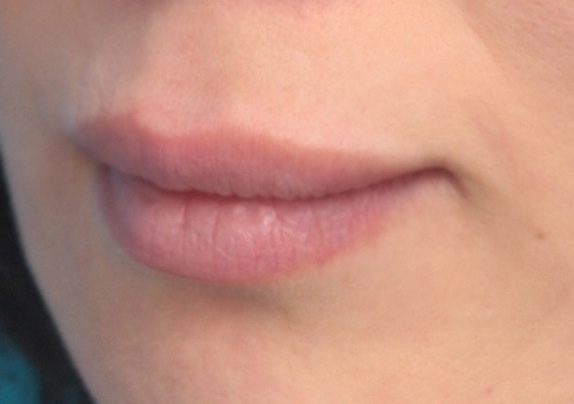 ヒアルロン酸で唇を厚く（ふっくら・アヒル口etc）,ヒアルロン酸で唇をふっくらさせて、軽いアヒル口にした症例写真,After,ba_atsuku17_b.jpg