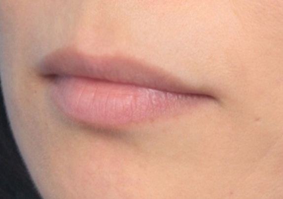ヒアルロン酸で唇を厚く（ふっくら・アヒル口etc）,ヒアルロン酸で唇をふっくらさせて、軽いアヒル口にした症例写真,Before,ba_atsuku17_b.jpg